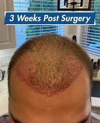 redness after hair transplant how to