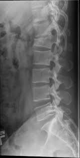 A fracture is when the continuity of a bone is broken. Lumbar Spine Compression Fracture Radiologypics Com