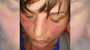 pictures of lupus how to recognize and