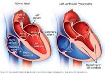 Image result for icd 9 code for atrial enlargement