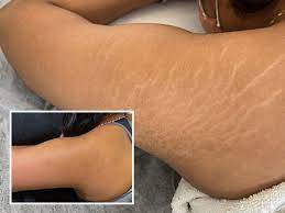 stretch mark removal how does it work