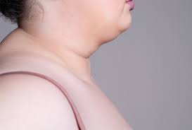 neck fat causes reduce it with surgery
