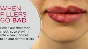 dermal filler lumps after lip
