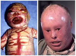 It is characterized by thickened, dry. Tales From Honduras Ichthyosis An Unusual Skin Finding Brown Emergency Medicine