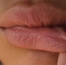 after lip filler