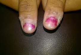 best keloid nail diseases treatments