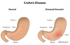 causes of postprandial pain you should know