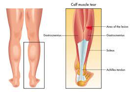 calf pain physiotherapy thrive physio