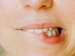 cold sore in es causes remes