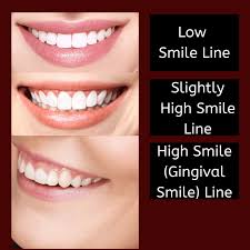 what is the gingival smile line west