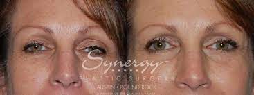 eyelid surgery blepharoplasty before
