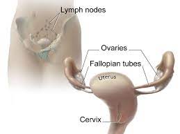 lymph node surgery for advanced ovarian