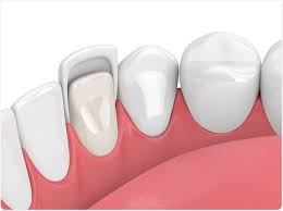 Dental Veneers: Procedure and Safety