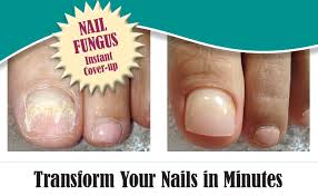 nail fungus treatment podiatrists in