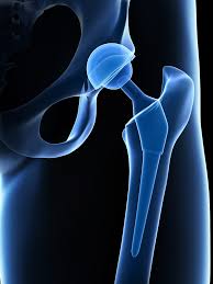 total hip replacement surgery