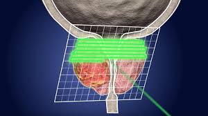 prostate cancer treatment scca proton