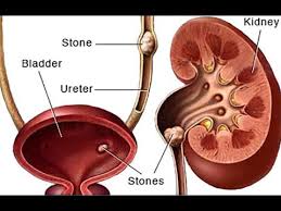 Treatment Chart For Kidney Stones A Diet
