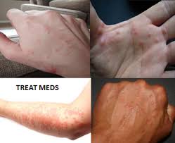 Over a sounds like you: Itchy Rash On Hands Feet Arms Causes Treatments And Home Remedies Itchy Rash Rash On Hands Itchy