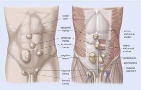 incisional hernia repair by dr david w