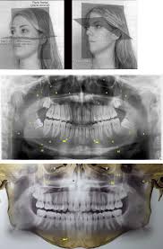 A radiologia odontológica engloba o raio x da boca ( dentes, gengiva, maxilares, entre outros). Radiologia Radiografia Panoramica Radiologia