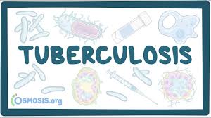 Tuberculosis (tb) is a dreaded bacterial infection. Tuberculosis Causes Symptoms Diagnosis Treatment Pathology Youtube