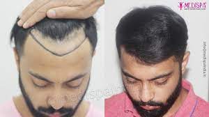 best hair transplant doctor in india