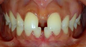There is also a wire that is visible across your teeth. Everything You Need To Know About Spaces Gaps Between Teeth