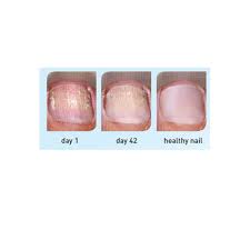 excilor nail fungus treatment 3 3ml