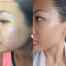 The best blackhead removal videos of 2018 12/27/2018 tell your friends. Cosrx Bha Blackhead Power Liquid Before After Results By Let S Face It Australia Medium