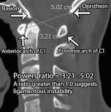 Image result for icd 10 code for fracture of occipital bone