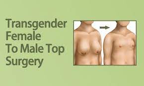female to male top surgery