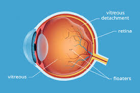 eye floaters treatment and causes