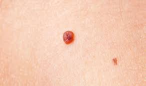 There are a number of different treatments doctors recommend. Skin Cancer Symptoms Tumour Cases Rise Signs To Look Out For And How To Prevent It Express Co Uk