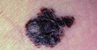 symptoms and pictures of se 4 melanoma