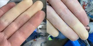 disease causes white or blue fingers