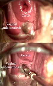 Normally, the tissue that lines a woman's uterus, known as the endometrium, is found only in the. Role Of Medical Therapy In The Management Of Deep Rectovaginal Endometriosis Fertility And Sterility