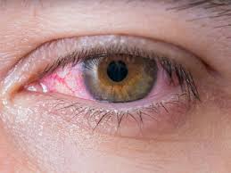 Sohati - علاج فيروس العين