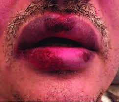 encrusted ulcers on lips