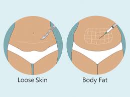 difference between fat and loose skin