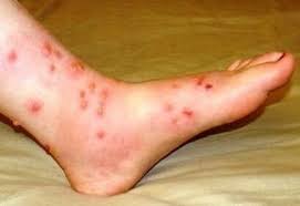 foot eczema causes symptoms