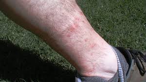 chiggers and no see ums how to avoid