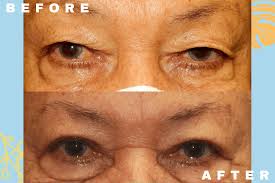 upper eyelid blepharoplasty honolulu