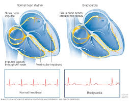 Bradycardia Symptoms And Causes Mayo Clinic