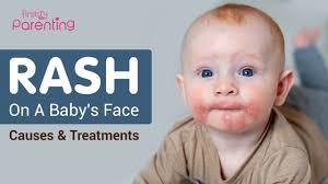 rash on baby s face reasons and