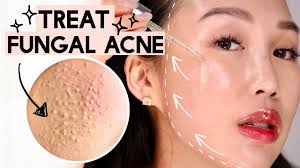 korean skincare to treat fungal acne