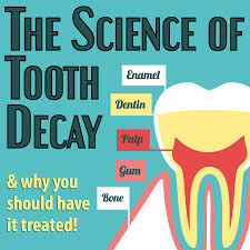 tooth decay in pleasant hill