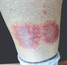 The lesions usually occur on skin covering joints like the knuckles or elbows. How To Recognize And Manage Granuloma Annulare