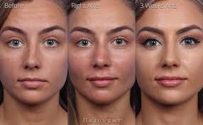 Pictured, zoe with her boyfriend before the procedure (left) and. Non Surgical Nose Sculpting Photos Rejuvent Medical Spa Scottsdale
