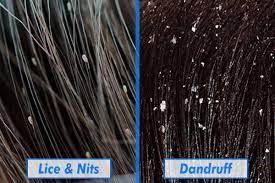 difference between lice nits and dandruff