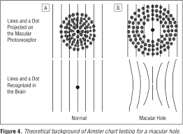 Figure 4 From The Visual Performance And Metamorphopsia Of